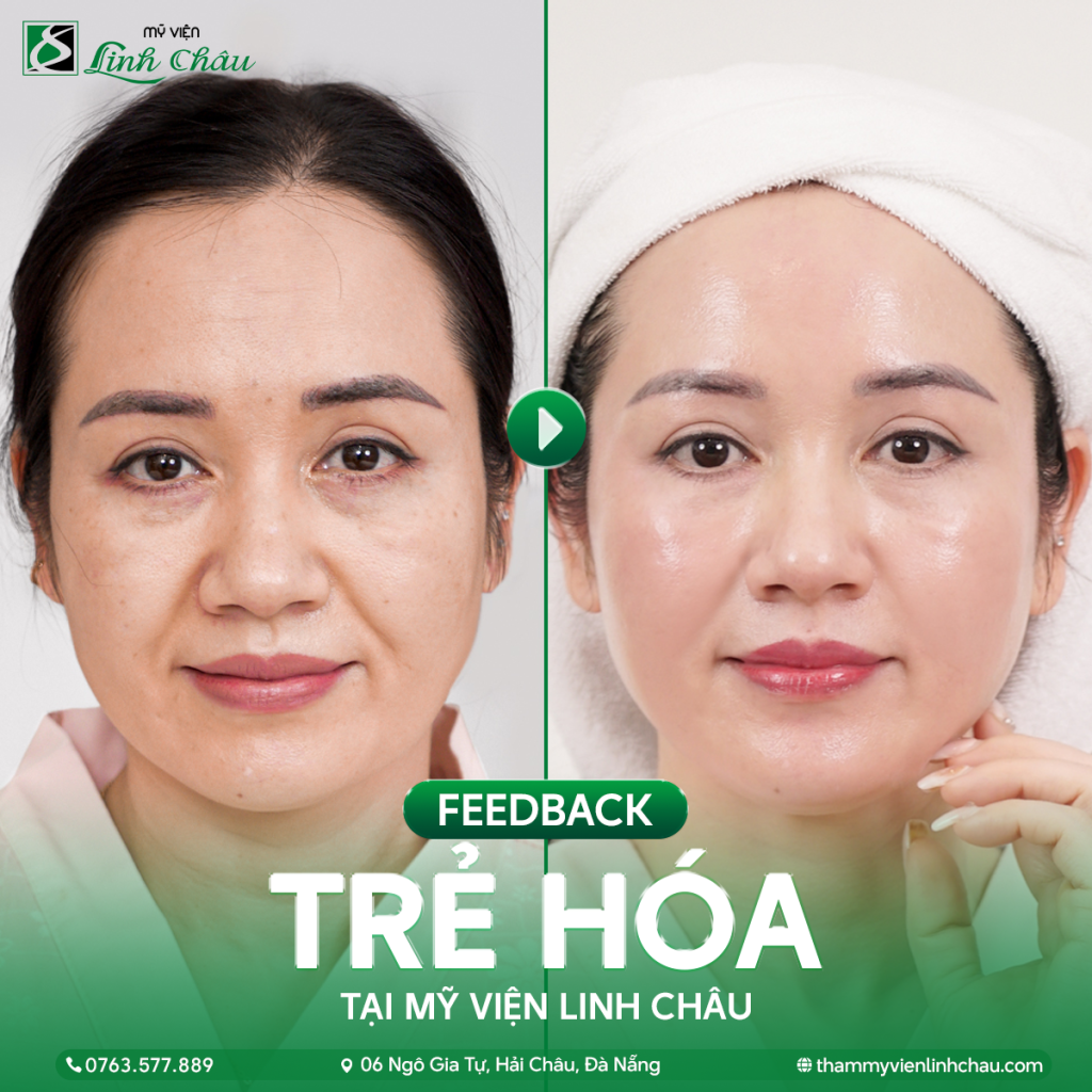 GIẢI PHÁP TRẺ HÓA DA TOÀN DIỆN TẠI TMV LINH CHÂU