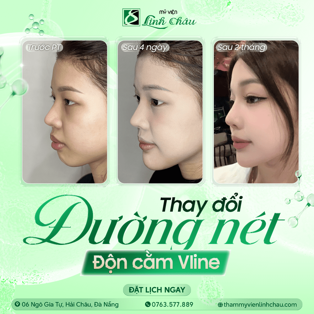 Các dáng mũi nâng tự nhiên 2026 được ưa chuộng nhất hiện nay