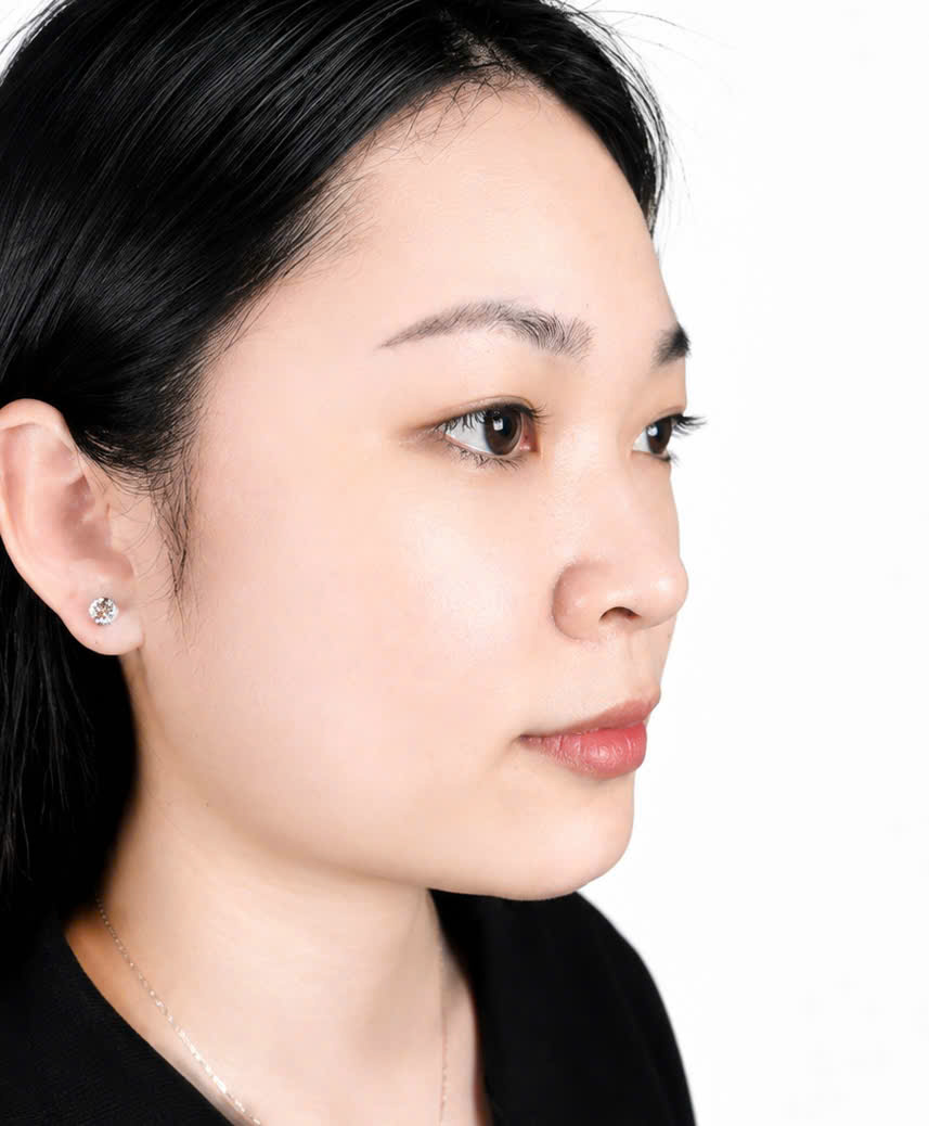 Trước khi Nâng mũi cấu trúc Soft Form Dr.Son