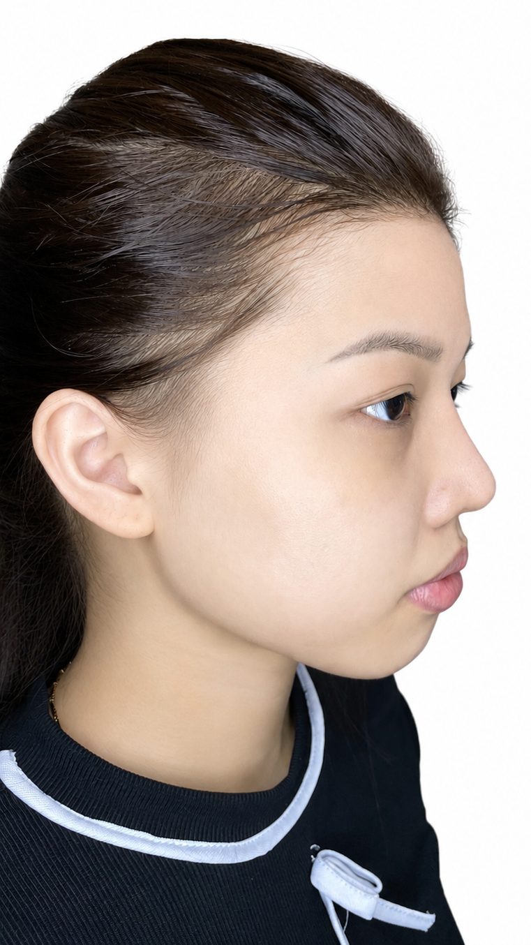 Trước khi Nâng cằm V-Line