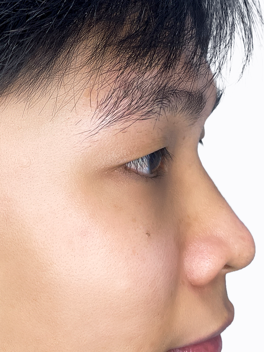 Trước khi Thẩm mỹ mắt